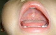 小兒皰疹性咽峽炎