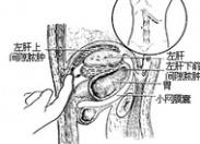 膈下膿腫