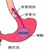 胃食管返流病 胃食管返流病