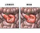 結腸扭轉