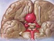 出血性腦梗死
