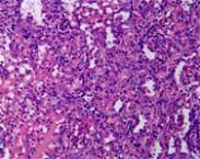 小兒彈性假黃瘤