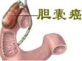 膽囊癌