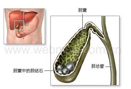 膽結石