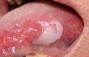軟腭癌