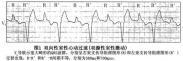 腎上腺素能依賴性尖端扭轉性室性心動過速 腎上腺素能依賴性尖端扭轉性室性心動過速