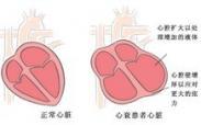 新生兒低鎂血癥