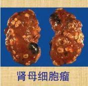 腎母細胞瘤 腎母細胞瘤