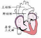 后天性三尖瓣關閉不全 后天性三尖瓣關閉不全