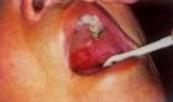 涎腺囊腫 涎腺囊腫