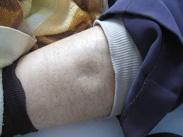 慢性腎小球腎炎