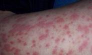 感染性血小板減少性紫癜 感染性血小板減少性紫癜