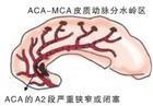 老年人分水嶺腦梗死 老年人分水嶺腦梗死