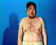腎上腺髓質(zhì)功能亢進(jìn)