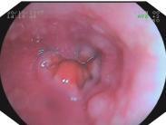 食管良性腫瘤 食管良性腫瘤