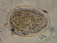 腦血吸蟲(chóng)病