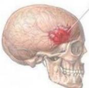 小兒硬腦膜下血腫