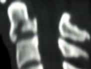 樞椎齒狀突骨折