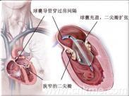 老年人鈣化性瓣膜病